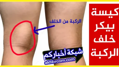كيسة بيكر خلف الركبة